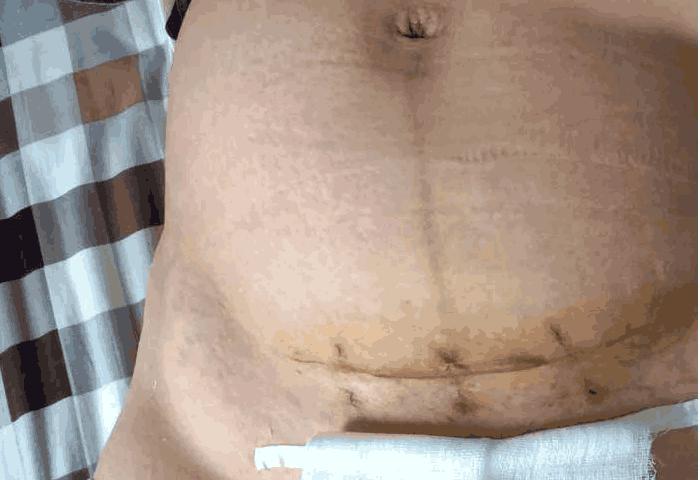 剖腹产打的麻药有什么副作用,剖腹产有哪些副作用和后遗症