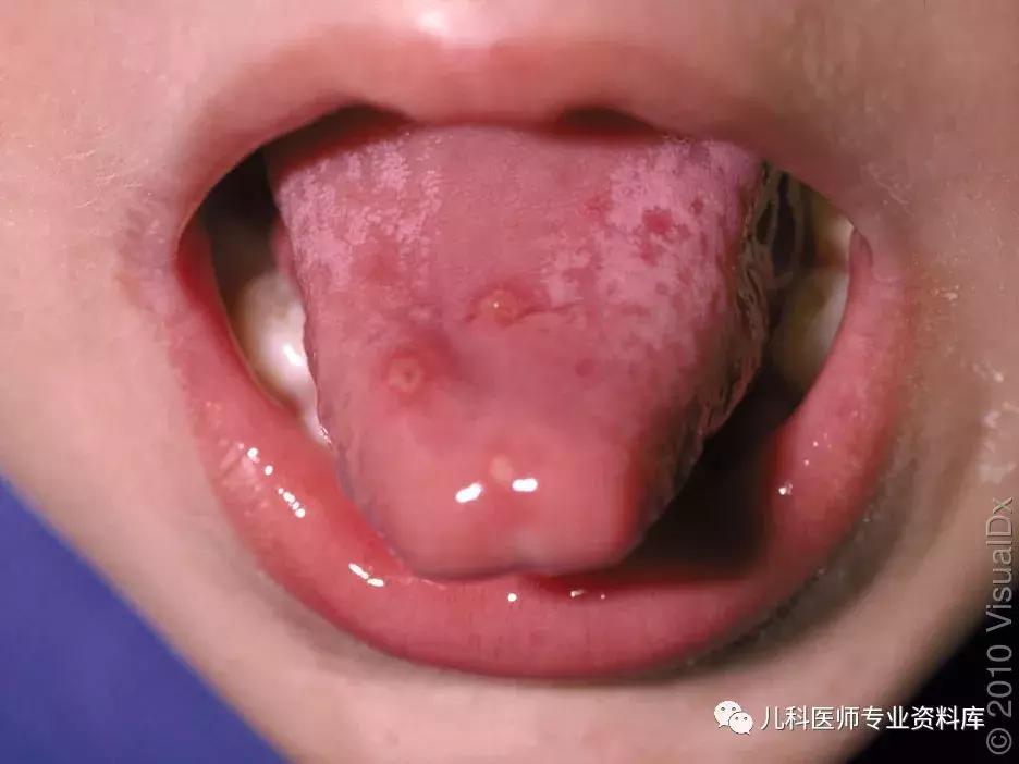 宝宝嘴巴上火的症状,宝宝嘴巴臭是积食还是上火