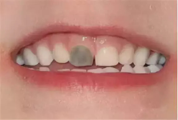 2岁宝宝牙齿全烂光，这5个问题不及时处理，孩子将来恨你一辈子