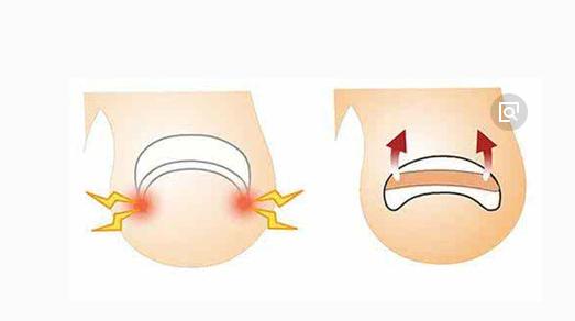 甲沟炎居然无需拔甲？这样治就能治好甲沟炎！