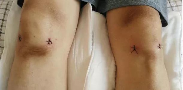 膝盖做关节镜手术多久能恢复,痛风关节镜手术多久可以恢复