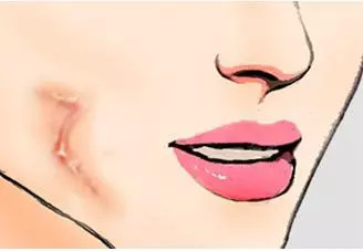 What？高血压降压药还能用来治疤痕？义乌这位整形专家耗费5年时间，取得科研新突破！