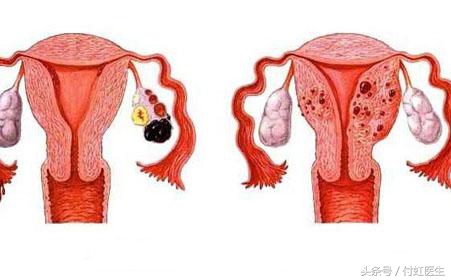 2cm的囊肿会导致痛经么,痛经一次比一次厉害怎么回事