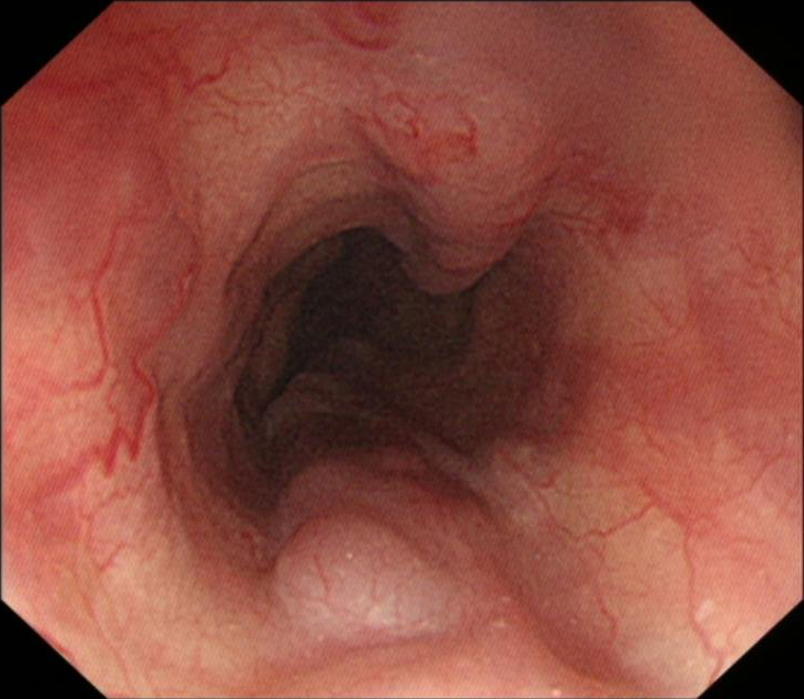 肝硬化中西医结合治疗并发症,肝硬化tips介入手术并发症