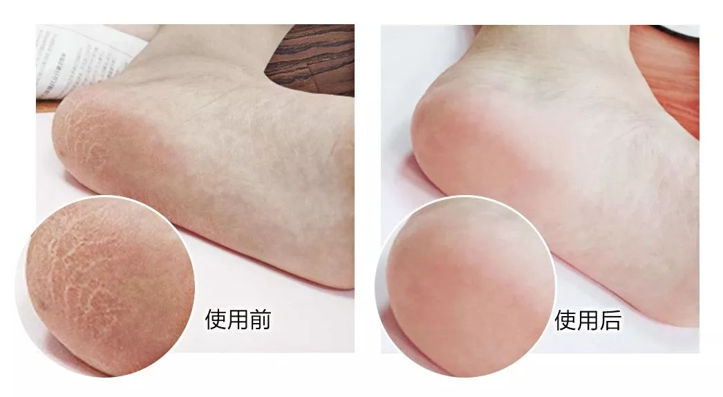 脚干裂脱皮的必备神器,脚部干裂起皮涂它全好了