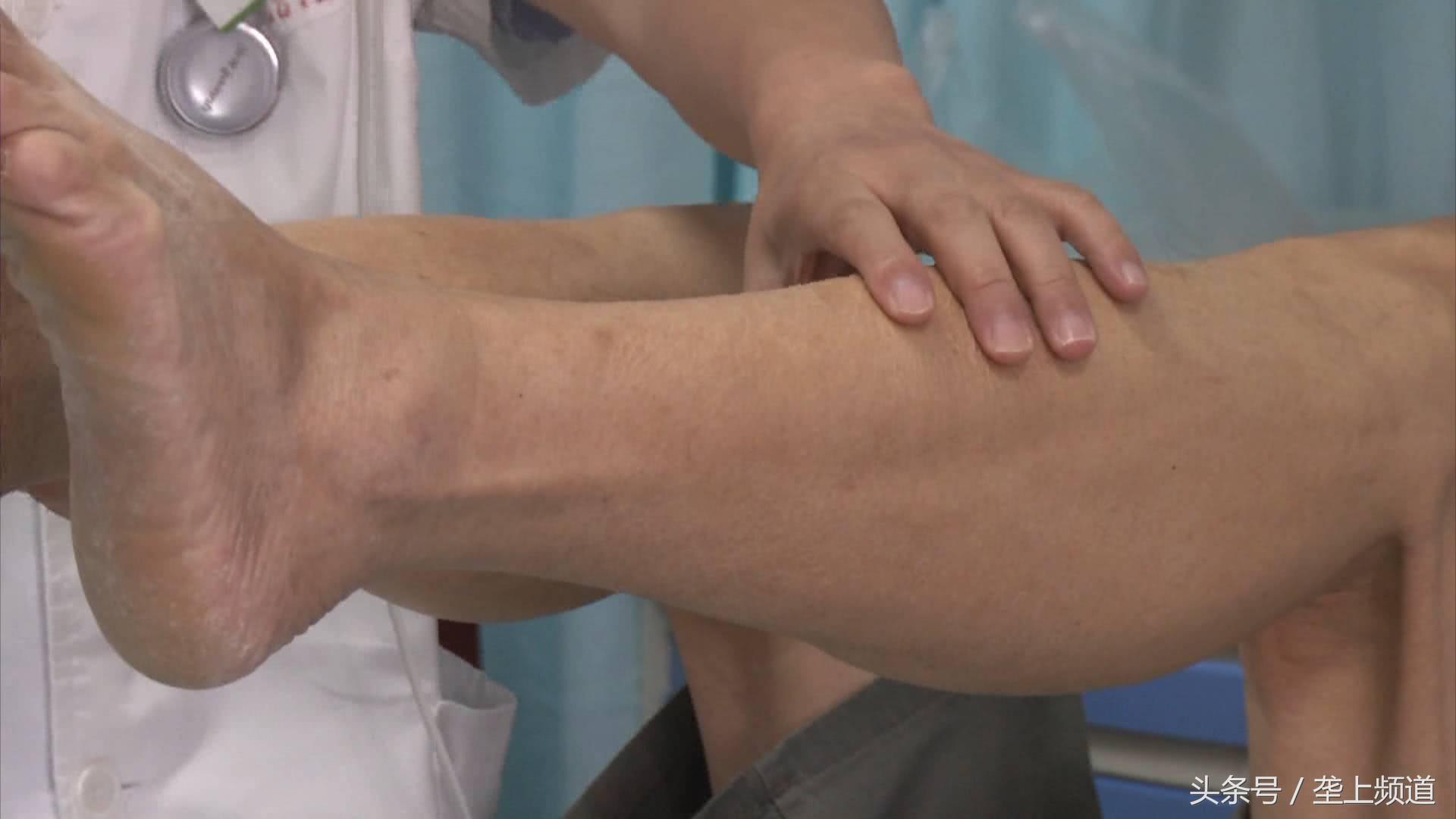 偏信坚持锻炼不吃抑制高血压的药，宜昌66岁大爷脑梗进医院！