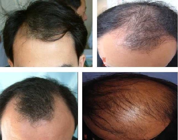 5个原因导致男人脱发,雄激素性脱发能治吗