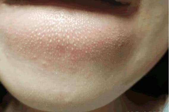 抿嘴出现的白色小颗粒,嘴下面起的密密麻麻大疙瘩是什么