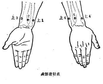 中医针刺绝招大全,针灸腕踝针位置示意图