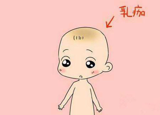 小宝宝头上胎垢可以洗掉吗,婴儿胎垢能洗掉吗