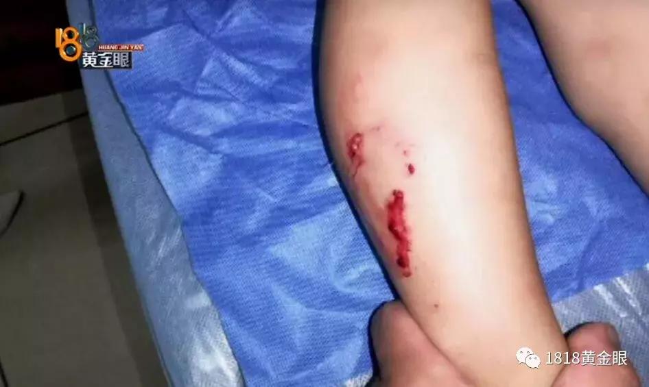 湖州6岁男童被狗咬伤,十几天后没了,确诊为狂犬病,听医生讲讲被狗咬伤后怎么处理