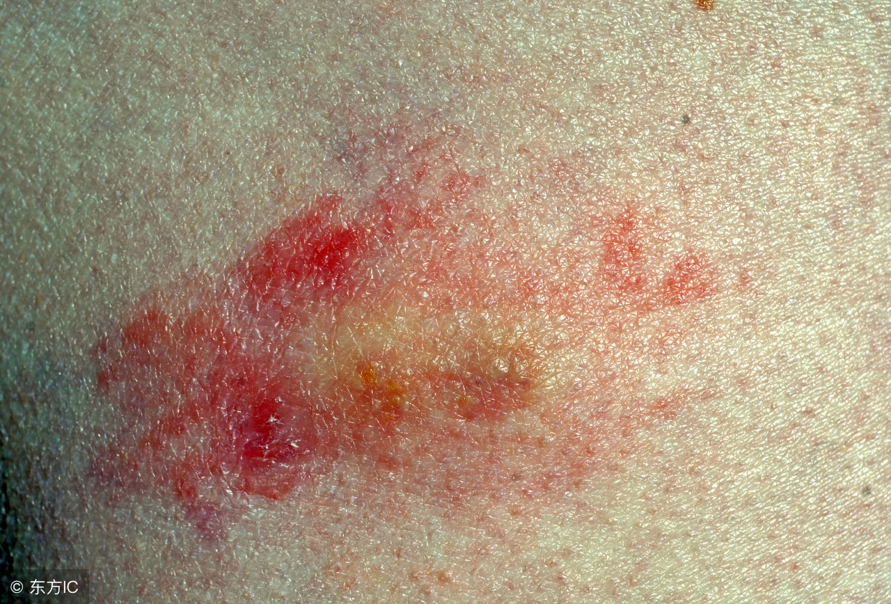 病毒性疱疹是怎么传染的呢？有哪些注意事项