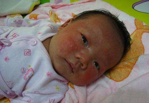 宝宝湿疹难缠,宝宝湿疹为什么反复发作该怎么办