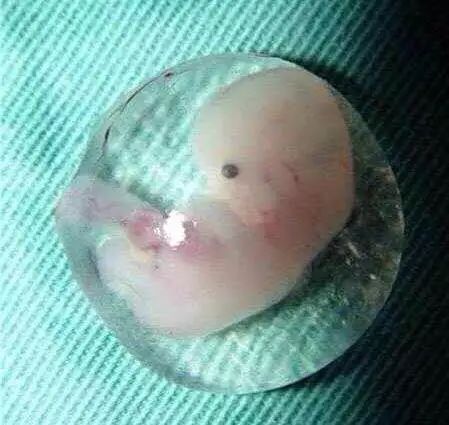 宫外孕要不要告诉男方家人,宫外孕温馨提示