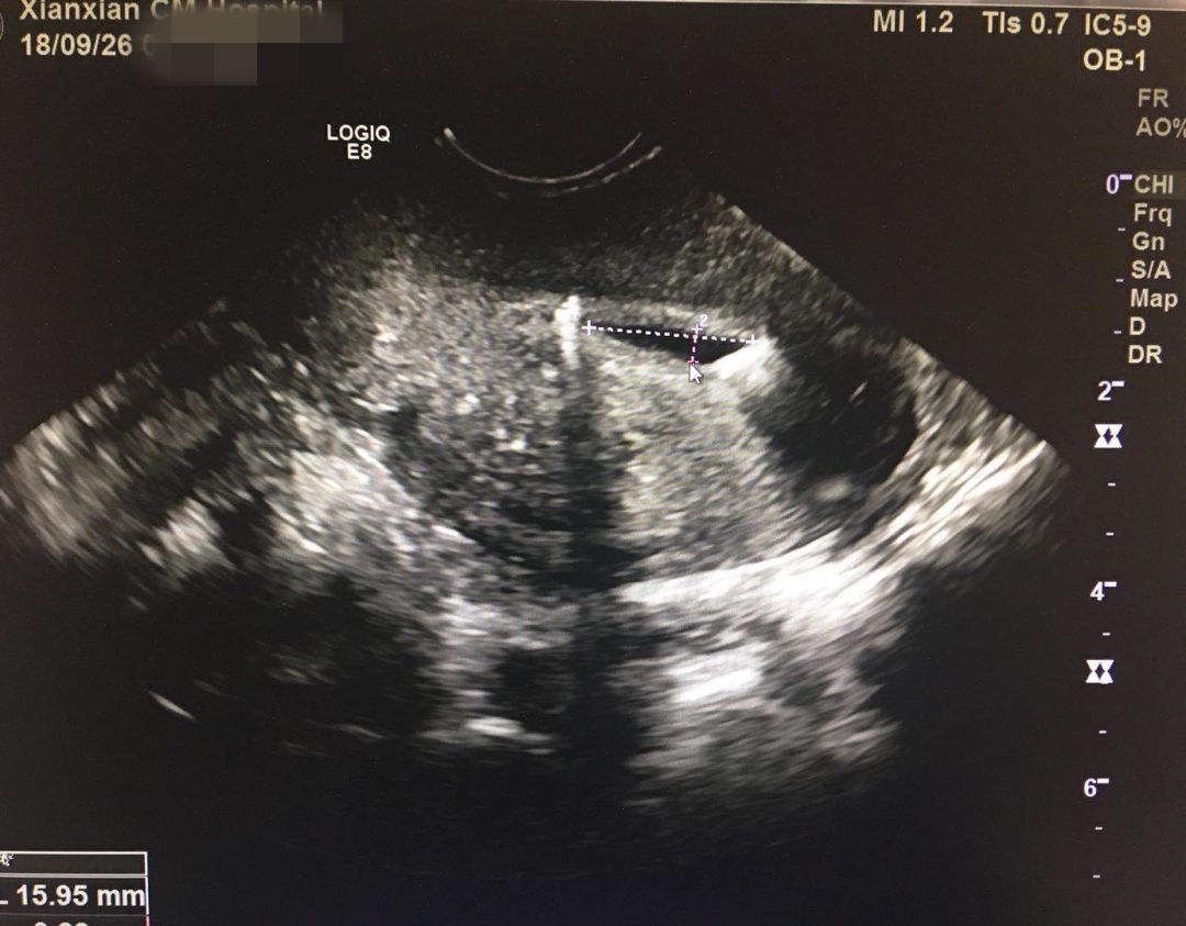 憋不住尿怎么做膀胱b超,膀胱b超必须憋好多尿吗