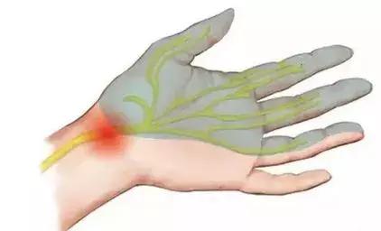 手麻、手疼、手无力，警惕“鼠标手”！