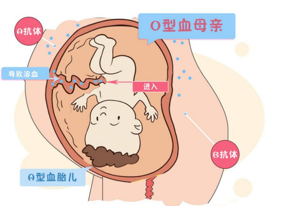 abo熊猫血中最稀有的血型,除熊猫血外什么常见血型最稀有