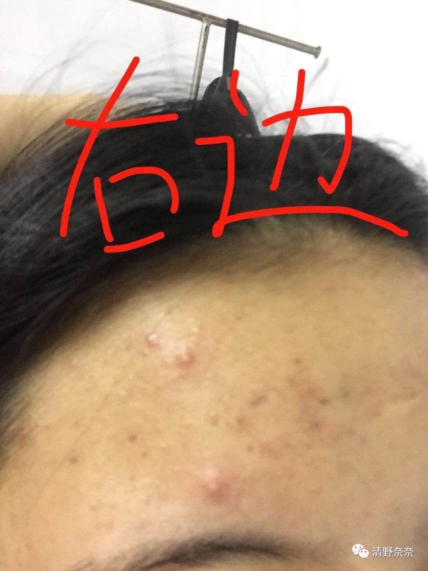 海绵微针后怎么护理,海绵微针第二天怎么护理