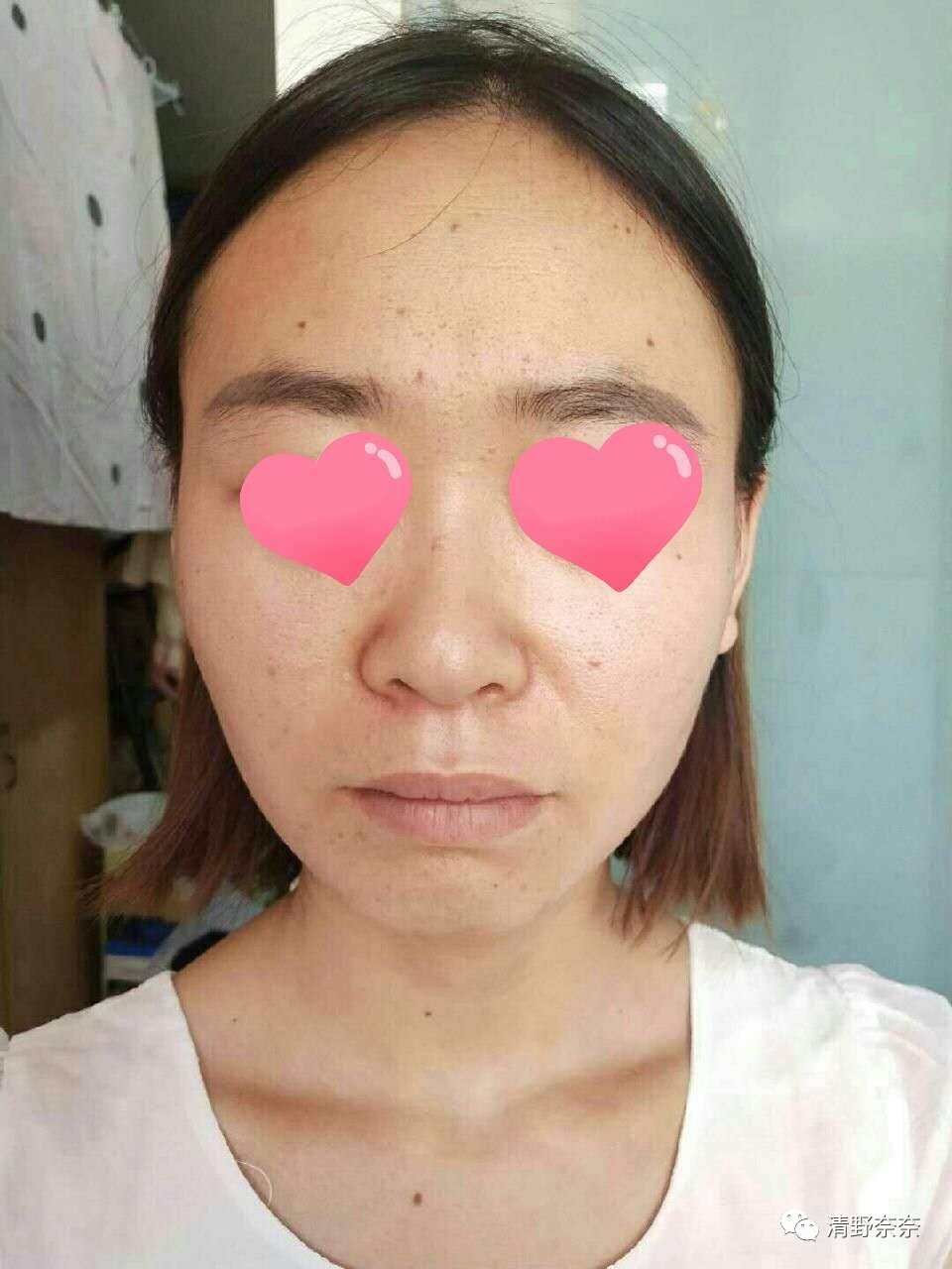 海绵微针后怎么护理,海绵微针第二天怎么护理