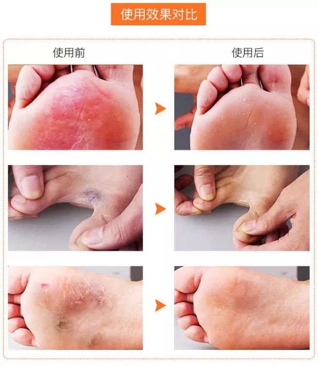 去脚气脚臭止痒最好的小妙招,去脚气脚臭止痒最好最快办法