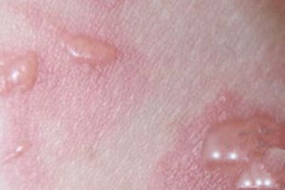 308准分子主要治疗什么,308准分子激光治疗白癜风需要多久