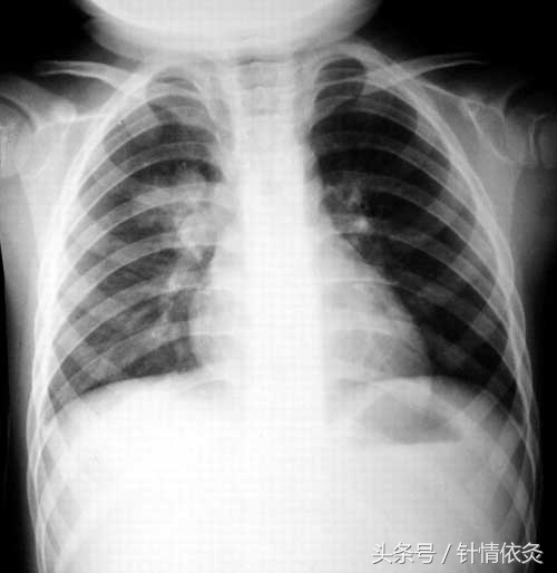 适宜针灸调理的常见病证-小儿肺炎可针灸