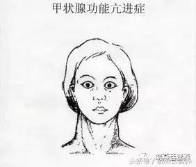 得了甲亢为什么总感觉有气,甲亢的人身上有股味道是怎么回事