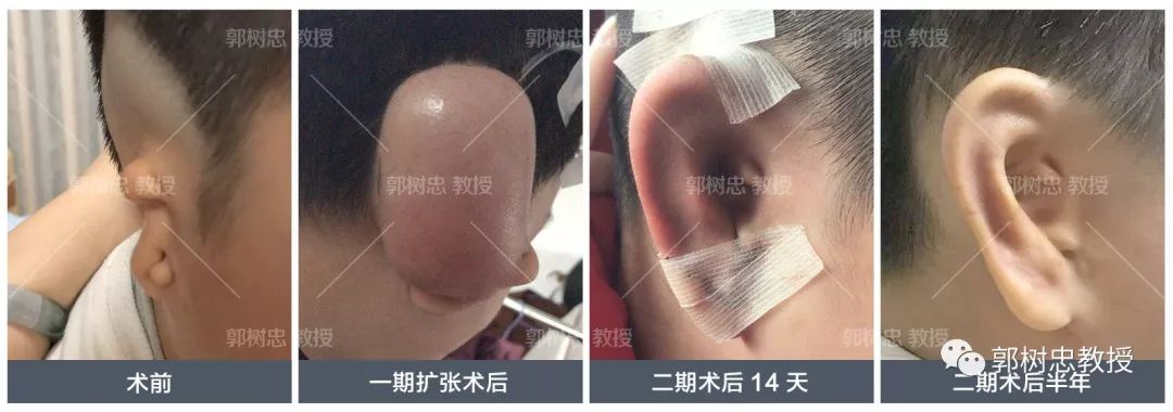 小耳症那些事儿（二十二）再造耳朵的厚度