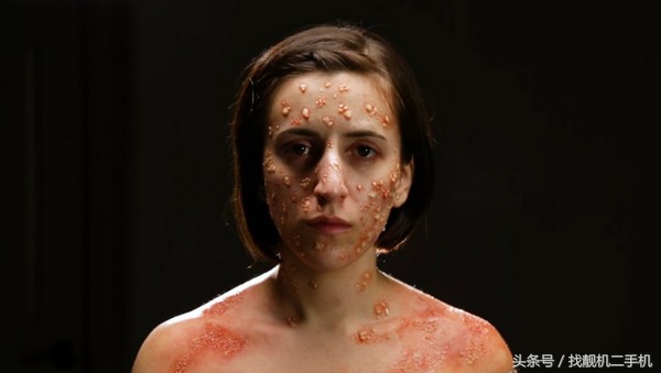 古代天花难治吗,古代天花大爆发