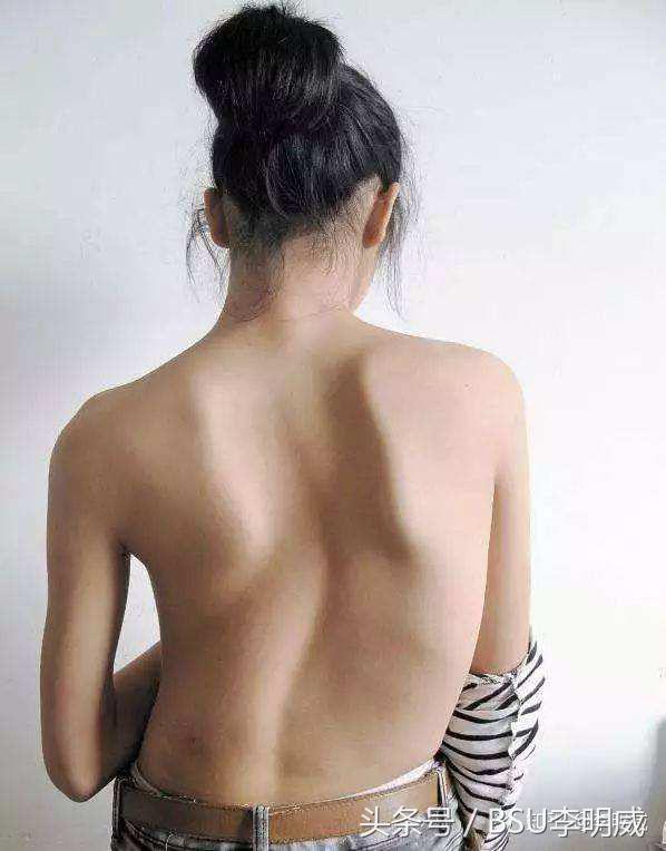 腰椎侧弯怎么办,儿童腰椎侧弯矫正视频