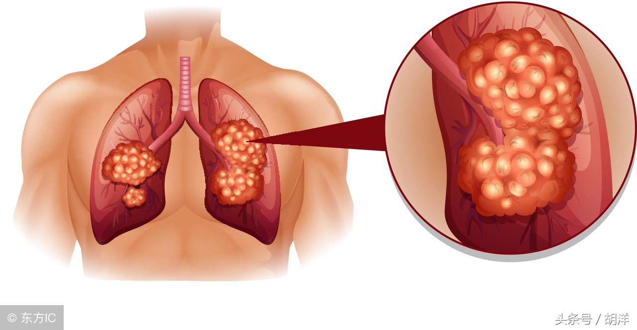 肺癌基因检测egfr是什么意思,肺癌中egfr是属于基因检测吗