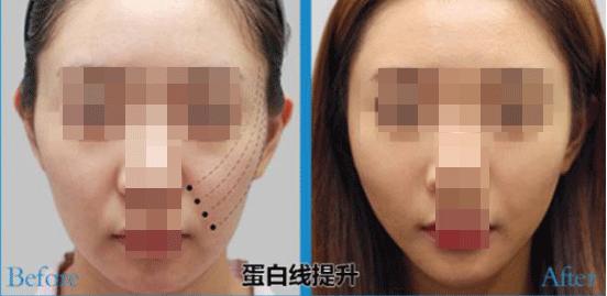 25岁脸皮肤松弛该怎么改善,脸皮肤松垮怎么补救