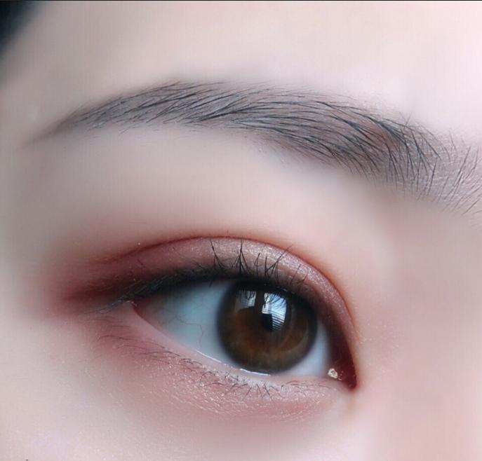 微创双眼皮开眼角3680元贵吗,纳米无痕双眼皮开眼角操作全过程