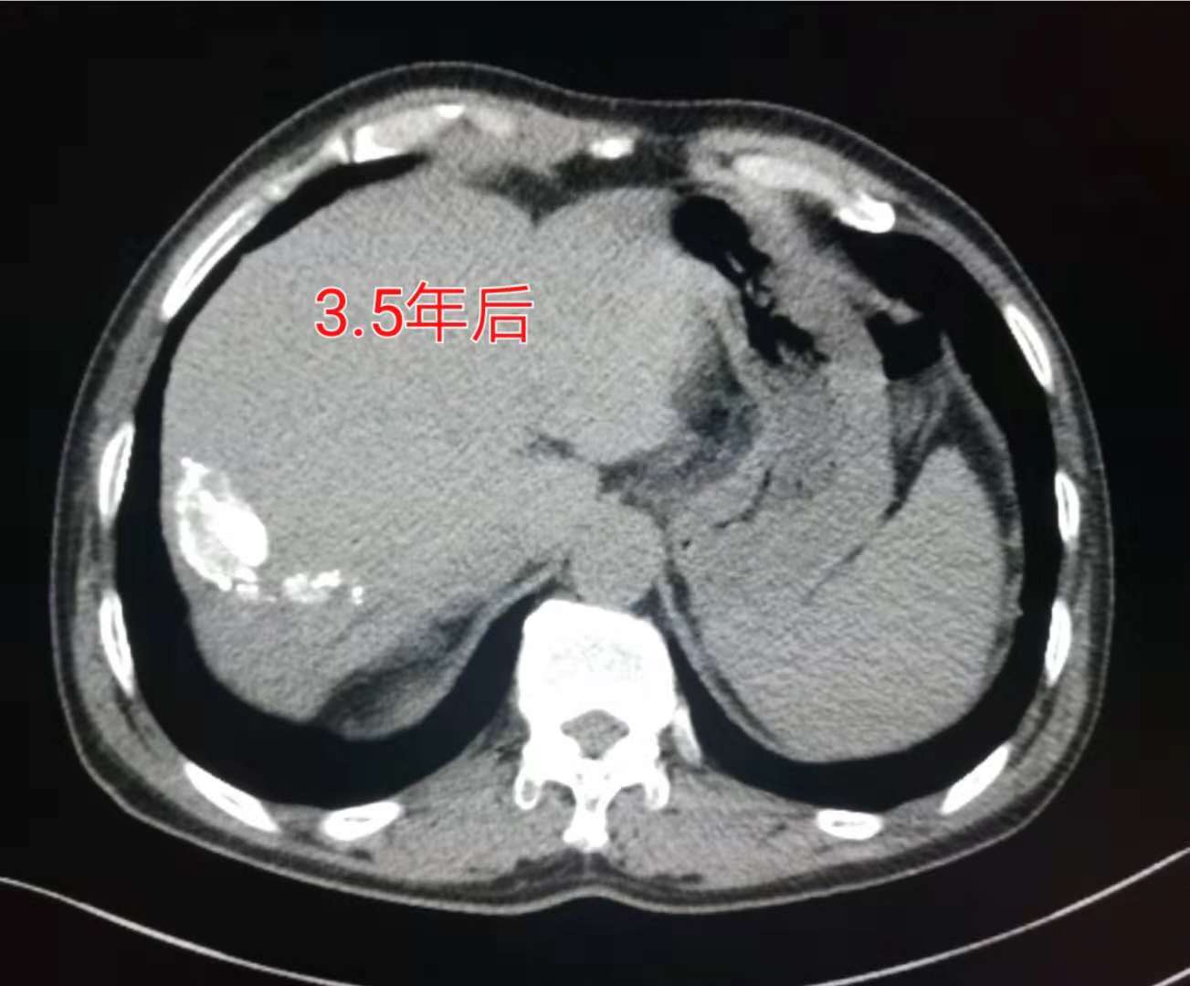 咳嗽几个月都没好会得肺癌吗,29岁女孩咳嗽一周肺癌