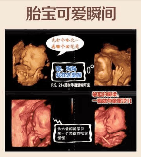 四维彩超宝宝不配合怎么办羊水少,四维产检宝宝不配合怎么办