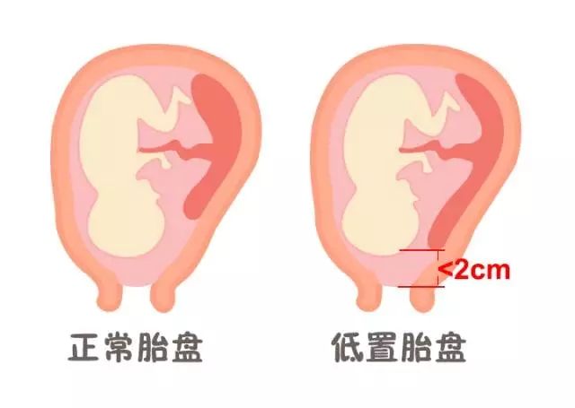 超声检查胎盘低置要怎么办,超声显示胎盘位置低要紧吗