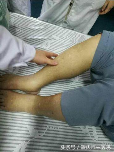 中医治疗老年人水肿的方法,肾病患者水肿久治不消怎么办
