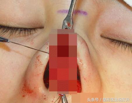 医生不会说的真相,隆鼻后鼻尖一直红是怎么回事