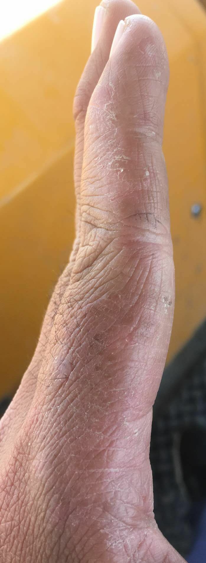 这些手的毛病，不用再愁，几块钱就能解决