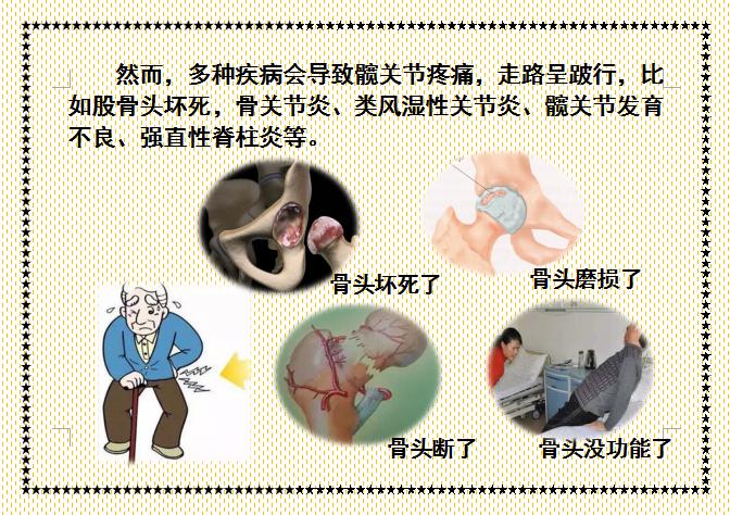 人工股骨头置换术术后教学查房,人工髋关节置换术后护理注意事项