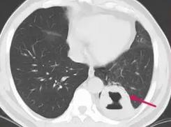 73岁老人肺上长3个结节有事吗,70多岁老人肺部有个拳头大的肿块