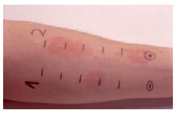 *麻疹荨**有哪些危害？该如何治疗和护理？一文让你读懂，这里都说了