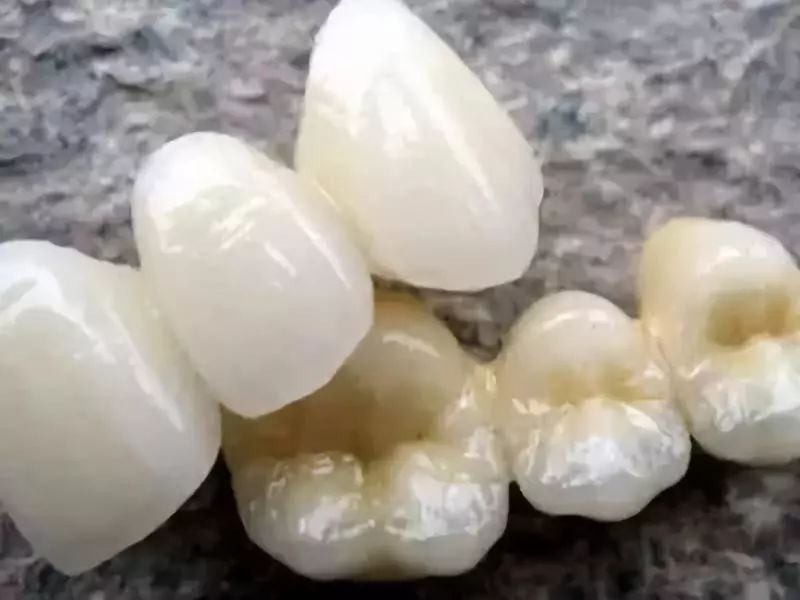 烤瓷牙与全瓷牙价格相差近十倍?究竟贵在哪?