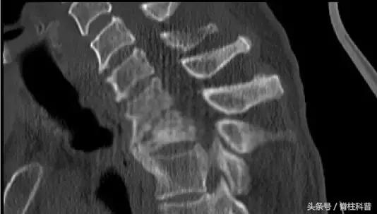 腰腿疼的防治误区,腰腿侧边疼怎么自测