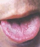 7种舌头暗示健康问题,各种病症舌头的颜色