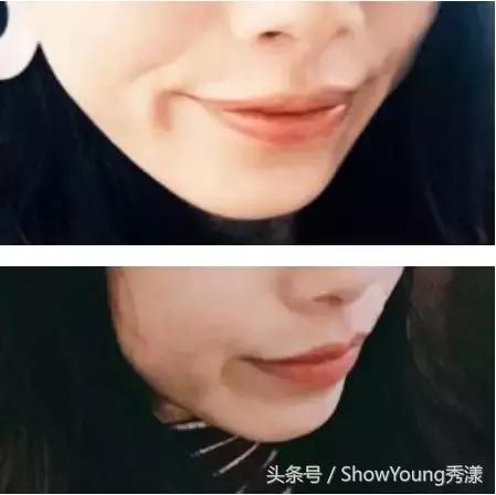 科普如何消除不同成因的法令纹,有法令纹与没有法令纹的区别