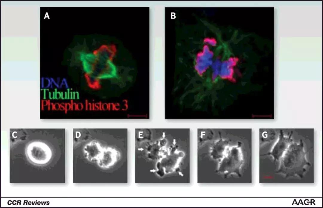 突破抗癌新药可治疗多种癌症视频,脉冲电场消融术治疗胰腺癌