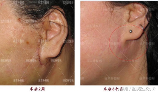 45岁做拉皮手术,44岁女人拉皮手术48天