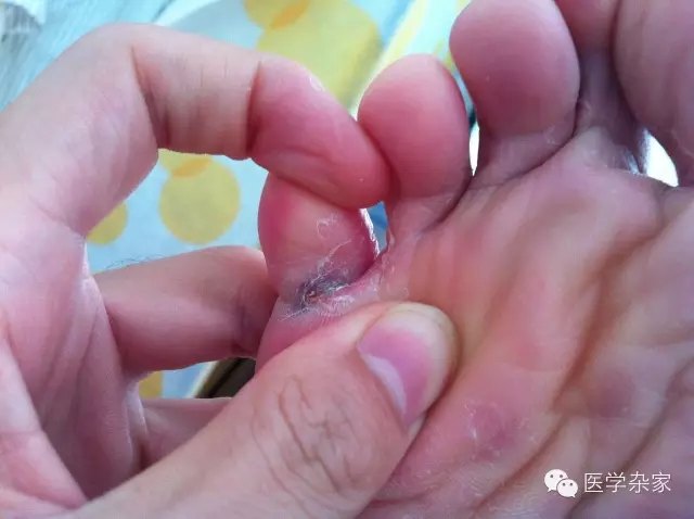 为什么脚气莫名其妙没有了,为什么脚气总是不能断根