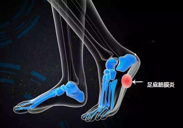 脚后跟疼长了骨刺怎么办,脚后跟痛还有骨刺怎么办啊